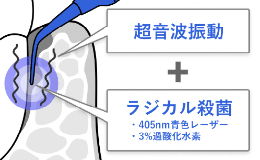 ブルーラジカル　超音波振動　ラジカル殺菌