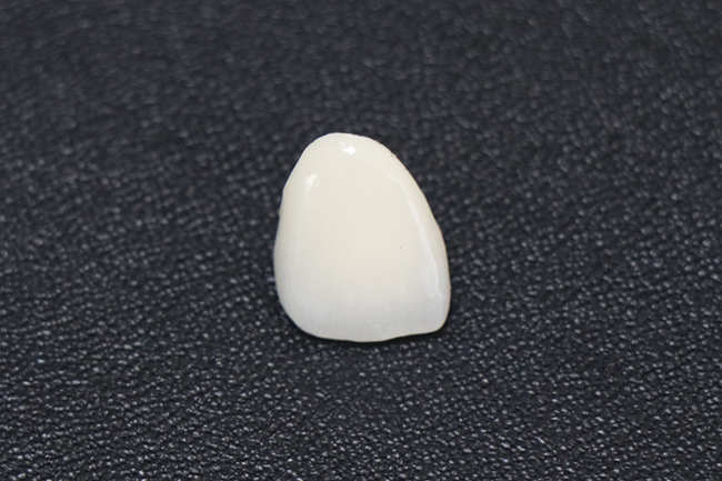 詰め物・かぶせ物 オールセラミックスクラウン