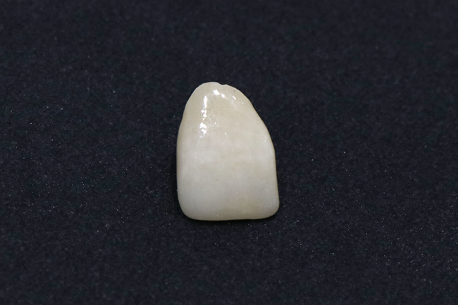 セラミックの詰め物・かぶせ物 ジルコニアクラウン(グラデーション)