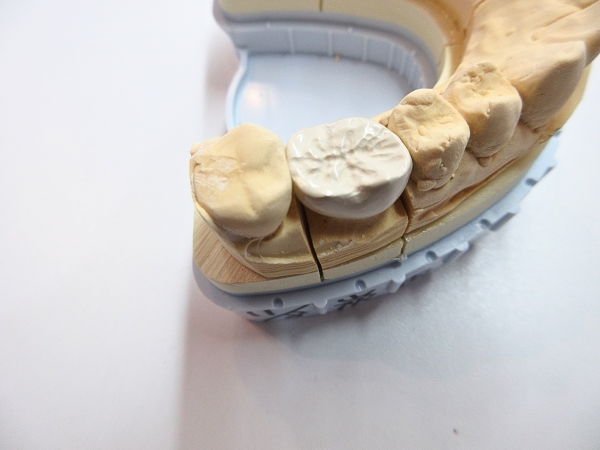 詰め物・かぶせ物 PEEK冠