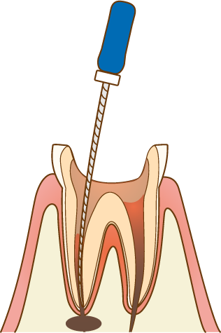 歯内療法