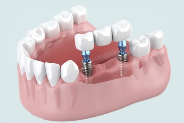 インプラント　人工歯根