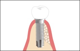 骨造成術　インプラント