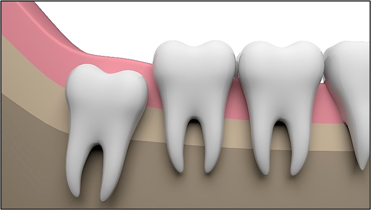 親知らず　抜歯