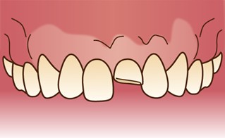 歯の脱臼　外傷