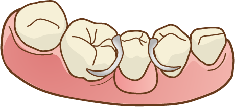 歯が抜けたあと