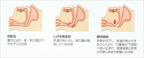 無呼吸症候群