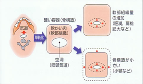 無呼吸症候群