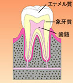 虫歯　歯の断面