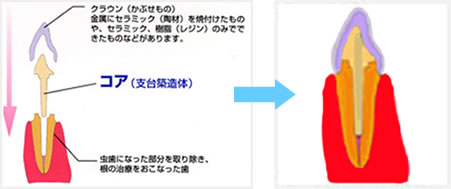 虫歯　差し歯の構造