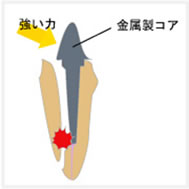 虫歯　金属製コア　破折