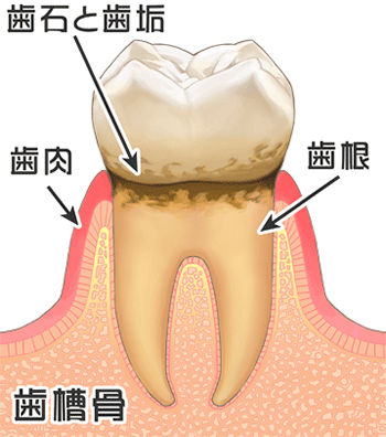 歯周病　歯石と歯垢　歯の状態