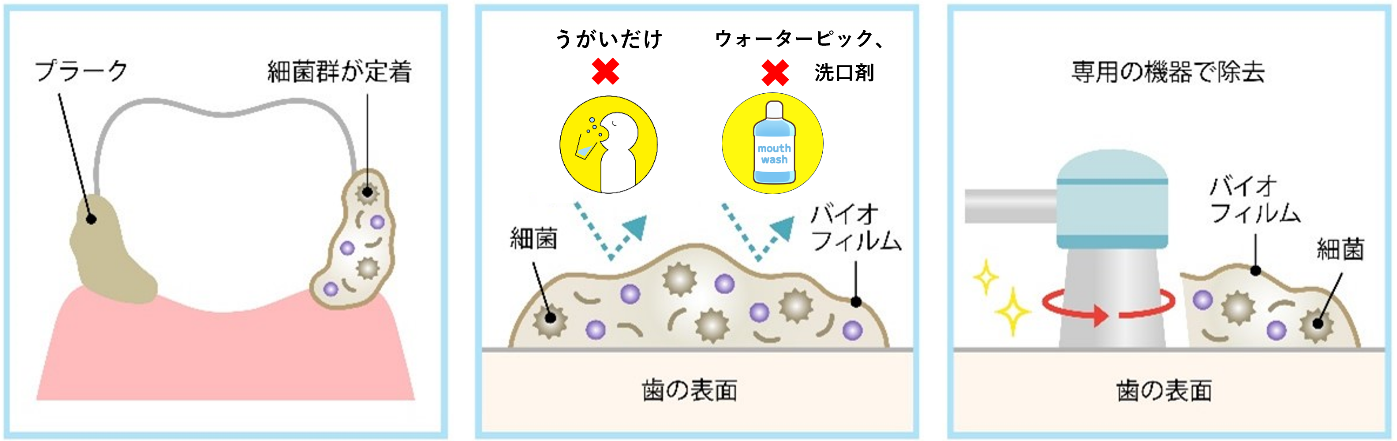 歯のクリーニング PMTC 治療風景