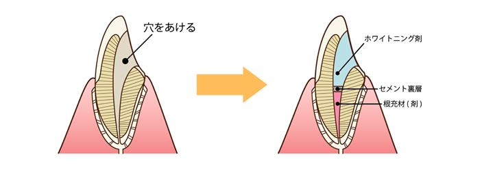 ウォーキングブリーチ　治療方法　歯の断面図