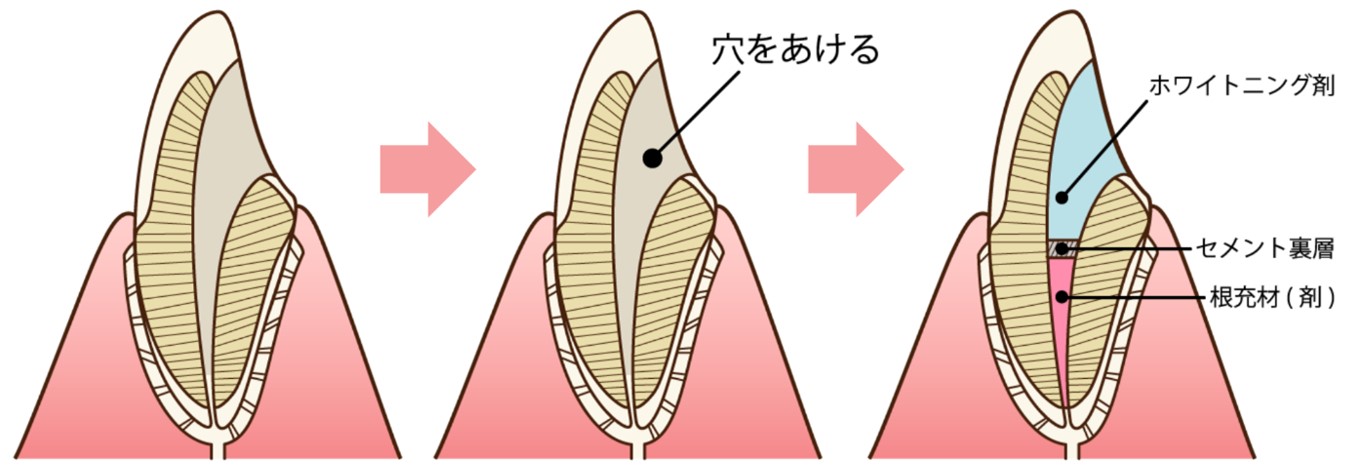 ウォーキングブリーチ　治療方法