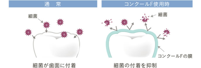 細菌の付着抑制