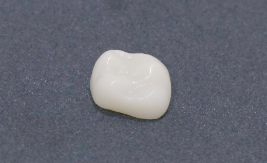 CAD/CAM冠　白いかぶせ物