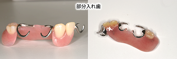 部分入れ歯　見本