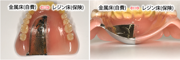 部分入れ歯　金属床