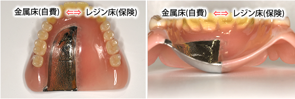 部分入れ歯