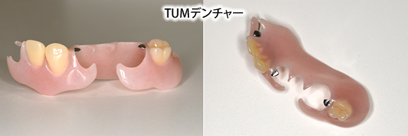 部分入れ歯　TUMデンチャー