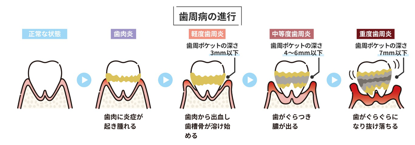 歯周病の進行　歯肉炎　歯周炎