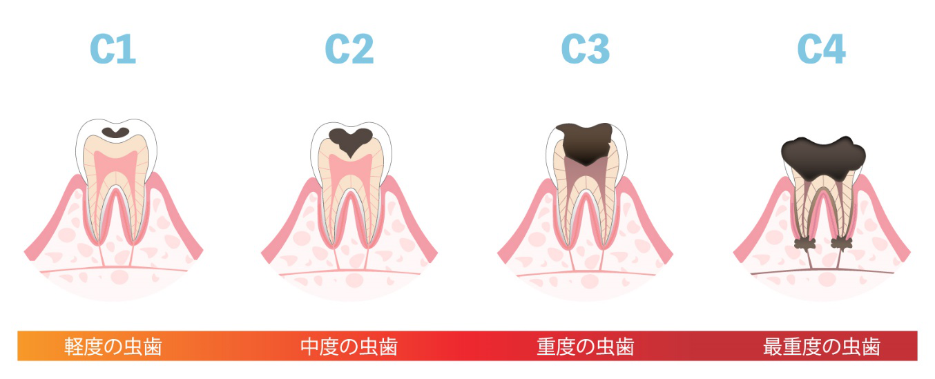 虫歯の段階 進行度