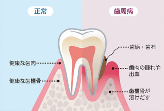 健康な歯肉　歯周病