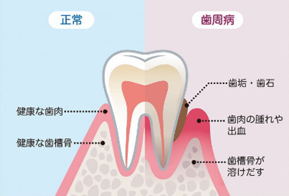 健康な歯肉と歯周病