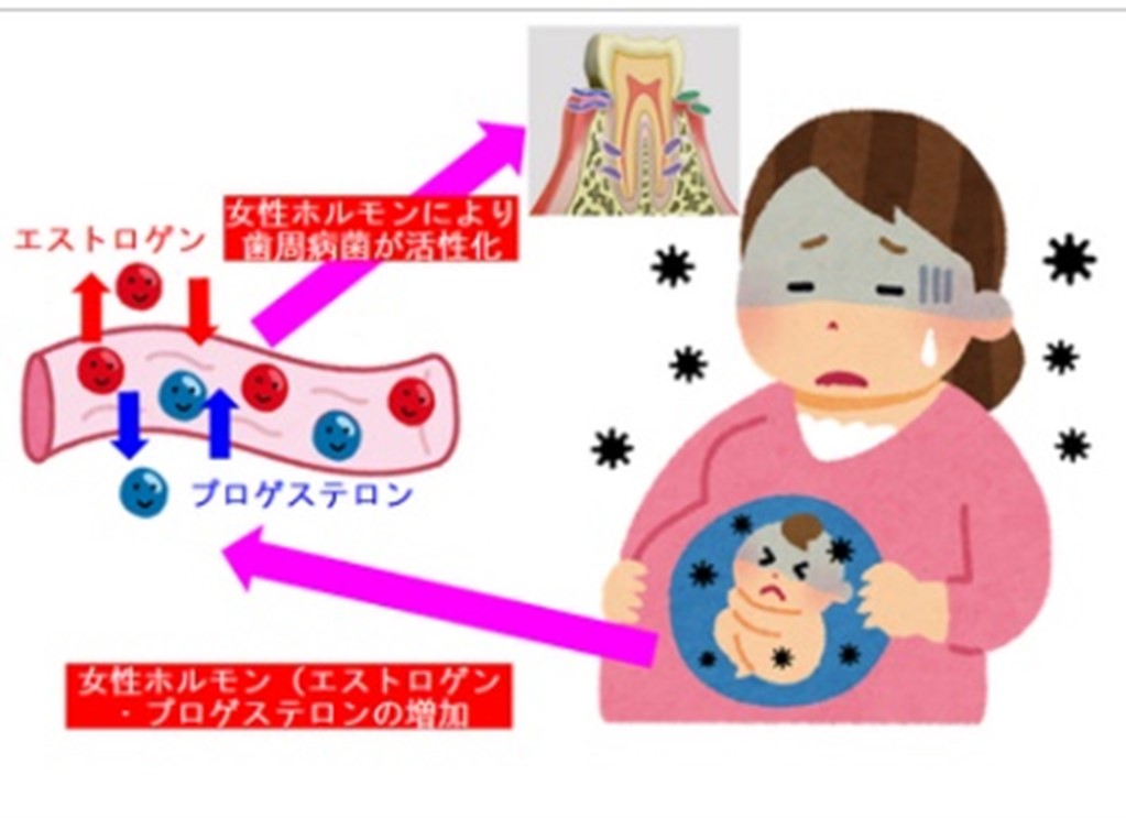 妊娠期のホルモンバランス　歯周病