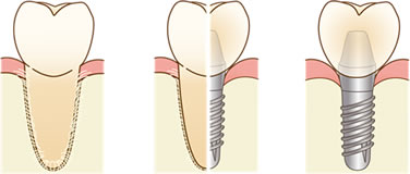 インプラント