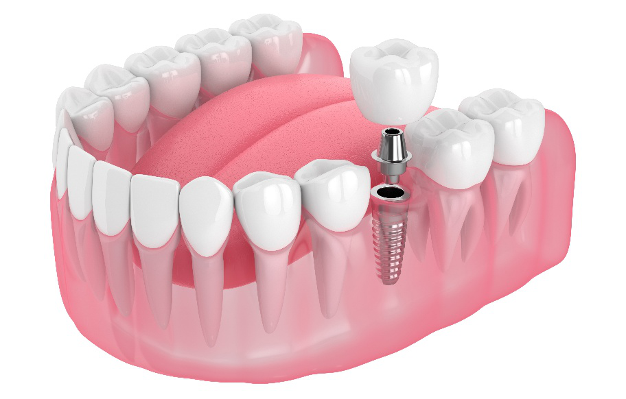 インプラント　模型