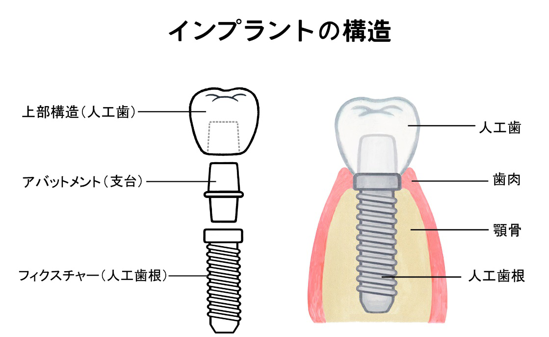 インプラントとは？　インプラントの構造
