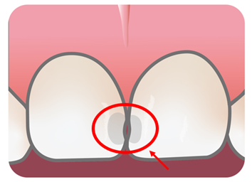 歯　隠れ虫歯　隣接面