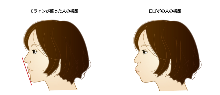 Eラインが整った人と口ゴボの人の横顔 矯正治療 嚙み合わせ