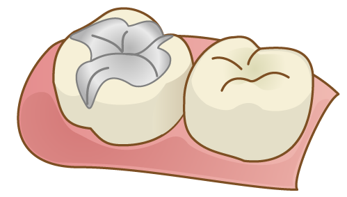 歯　詰め物　被せ物