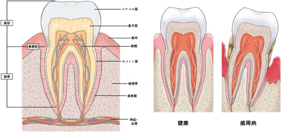 歯周病とは