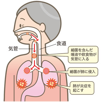 誤嚥性肺炎　図解
