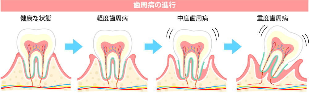 歯周病の進行