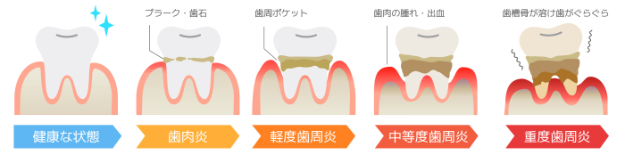 歯の汚れ 歯周病 プラーク