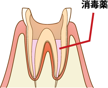 歯の内部