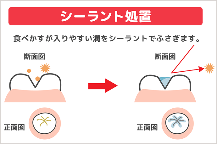 シーラント処置　説明図