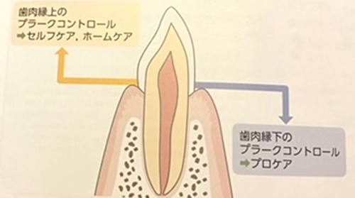 歯肉緑上　歯肉縁下　プラークコントロール