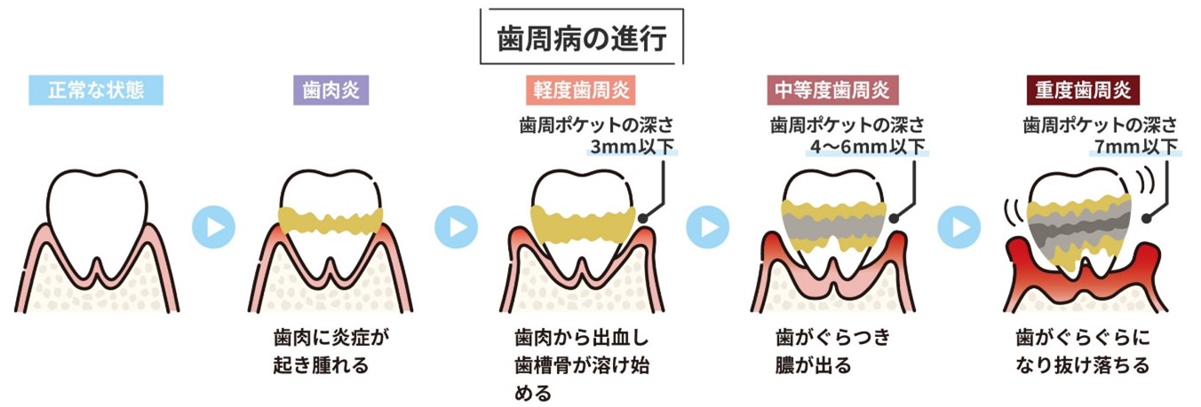 歯周病　進行図