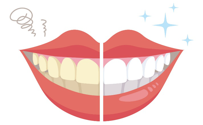 白い歯　ホワイトニング　笑顔