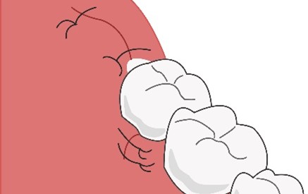 抜歯の手順　縫合
